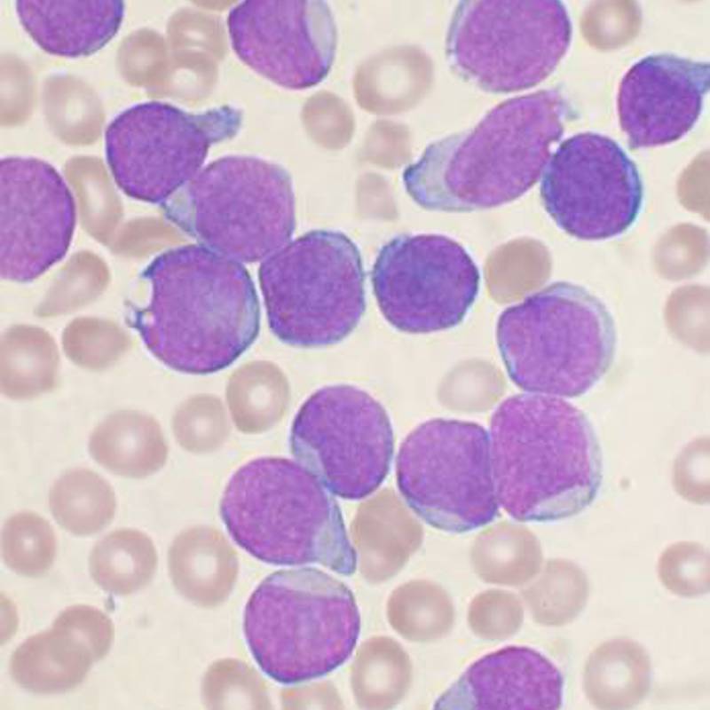Acute_leukemia-ALL.jpg
